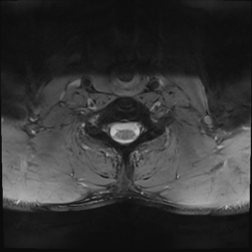 File:Normal trauma cervical spine (Radiopaedia 41017-43762 Axial T2 23).png