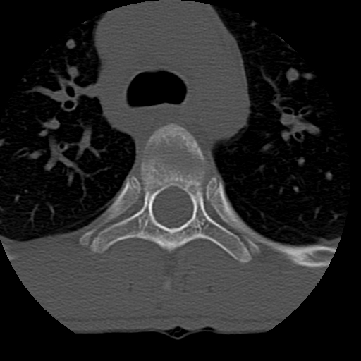 File:Normal trauma spine imaging (age 16) (Radiopaedia 45335-49358 Axial bone window 109).jpg