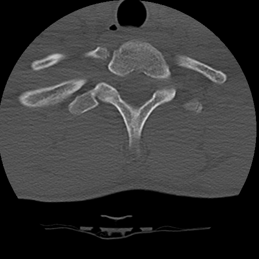 Normal trauma spine imaging (age 16) (Radiopaedia 45335-49358 Axial bone window 72).jpg