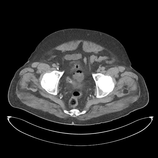 File:Obstructive pyelonephritis (Radiopaedia 46411-50844 Axial non-contrast 71).png