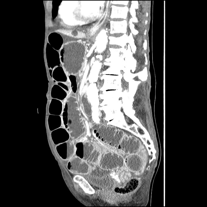 Obturator hernia causing small bowel obstruction (Radiopaedia 65522-74612 C 49).jpg