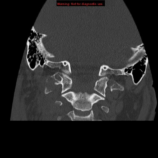 File:Occipital condyle fracture (Radiopaedia 18366-18208 Coronal bone window 13).jpg