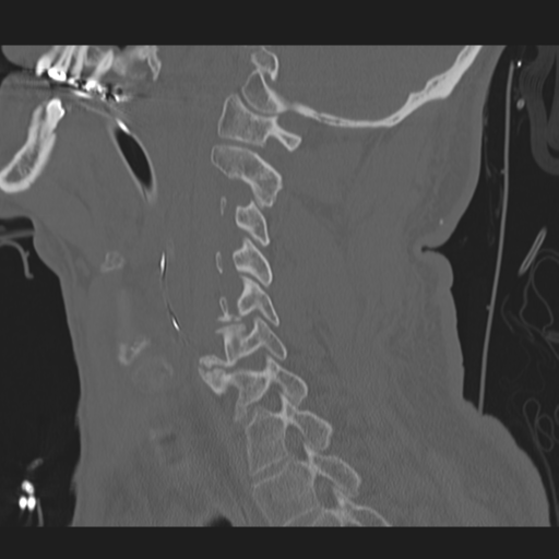 File:Occipital condyle fracture (Radiopaedia 33467-34517 Sagittal bone window 46).png