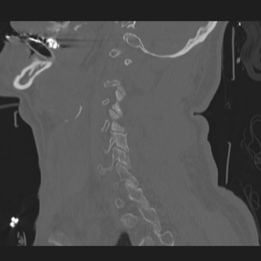 File:Occipital condyle fracture (Radiopaedia 33467-34517 Sagittal bone window 53).png