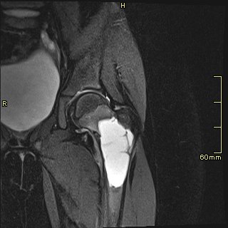 File:Unicameral bone cyst - left proximal femur (Radiopaedia 82836-99066 Coronal 9).jpg