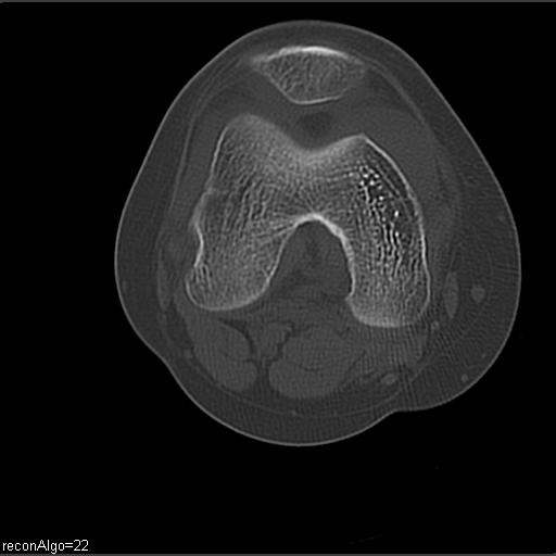 File:ACL avulsion fracture (Radiopaedia 33833-34994 Axial bone window 15).jpg