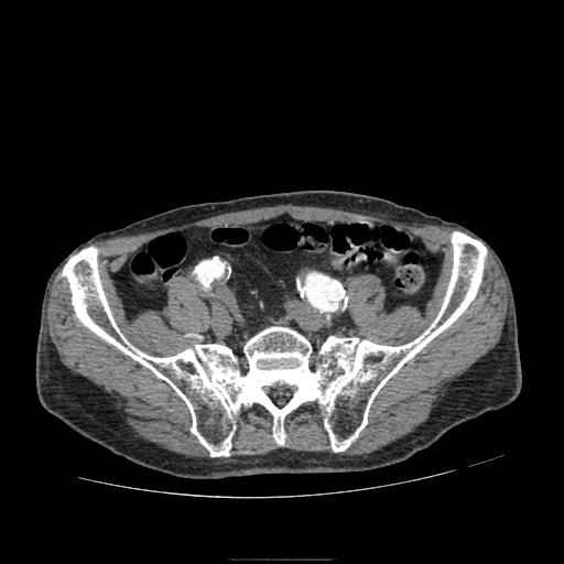 Abdominal aortic aneurysm (Radiopaedia 13341-13340 Axial C+ arterial phase 182).jpg