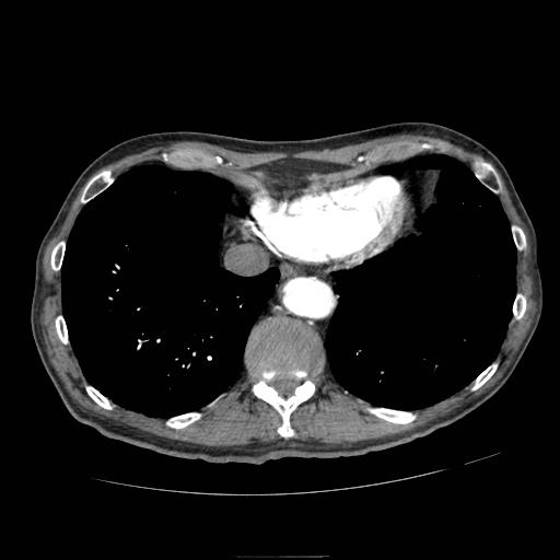 Abdominal aortic aneurysm (Radiopaedia 13341-13340 Axial C+ arterial phase 5).jpg