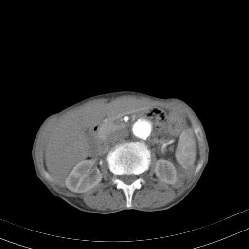 File:Abdominal aortic aneurysm (Radiopaedia 20827-20742 Axial C+ arterial phase 14).jpg