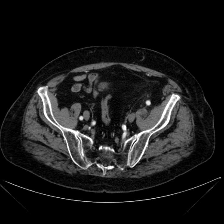 Abdominal aortic aneurysm (Radiopaedia 25855-26001 Axial C+ arterial phase 109).jpg