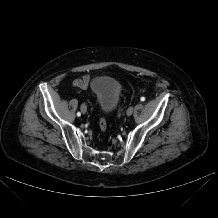 Abdominal aortic aneurysm (Radiopaedia 25855-26001 Axial C+ arterial phase 112).jpg