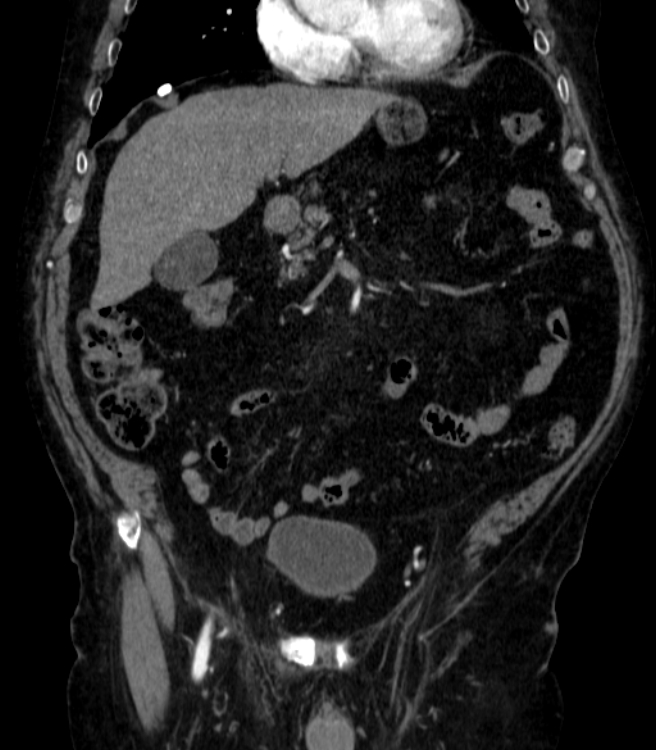 Abdominal aortic aneurysm (Radiopaedia 25855-26001 Coronal C+ arterial phase 11).jpg
