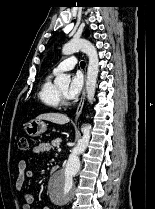 Abdominal aortic aneurysm (Radiopaedia 83094-97462 Sagittal renal cortical phase 69).jpg