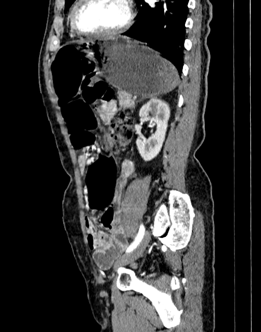 Abdominal aortic aneurysm (Radiopaedia 83581-98689 Sagittal C+ arterial phase 81).jpg