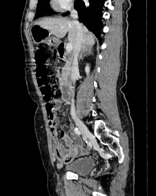 Abdominal aortic aneurysm (Radiopaedia 83581-98689 Sagittal C+ portal venous phase 24).jpg