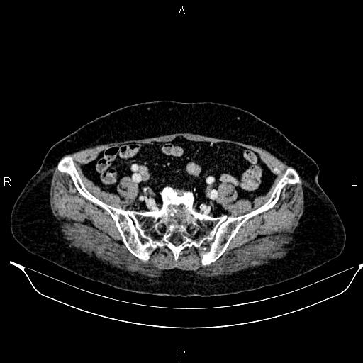 File:Abdominal aortic aneurysm (Radiopaedia 85063-100606 Axial C+ portal venous phase 55).jpg