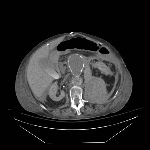 Abdominal aortic aneurysm - impending rupture (Radiopaedia 19233-19247 Axial non-contrast 73).jpg