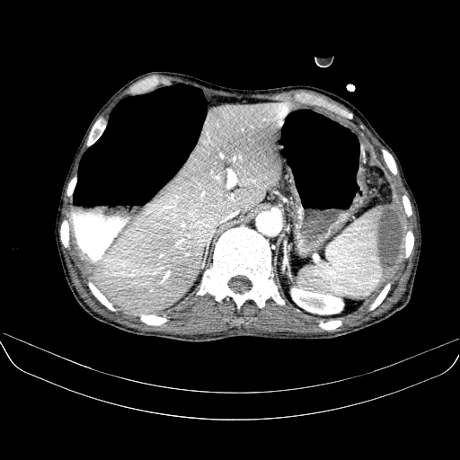 File:Abdominal collection due to previous cecal perforation (Radiopaedia 80831-94320 Axial C+ portal venous phase 45).jpg