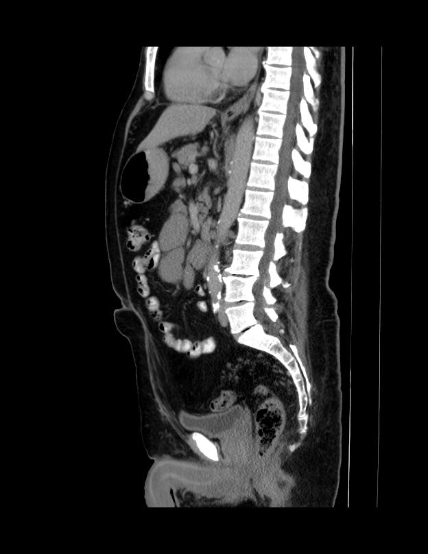 Abdominal lymphoma - with sandwich sign (Radiopaedia 53486-59492 Sagittal C+ portal venous phase 38).jpg