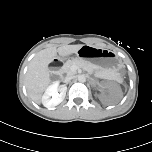 File:Abdominal multi-trauma - devascularised kidney and liver, spleen and pancreatic lacerations (Radiopaedia 34984-36486 Axial C+ delayed 25).png