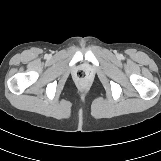 File:Abdominal multi-trauma - devascularised kidney and liver, spleen and pancreatic lacerations (Radiopaedia 34984-36486 Axial C+ delayed 83).png
