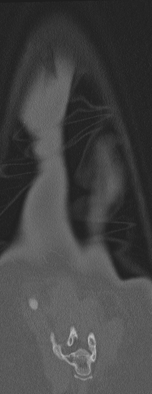 Abdominal multi-trauma - devascularised kidney and liver, spleen and pancreatic lacerations (Radiopaedia 34984-36486 Coronal bone window 72).png