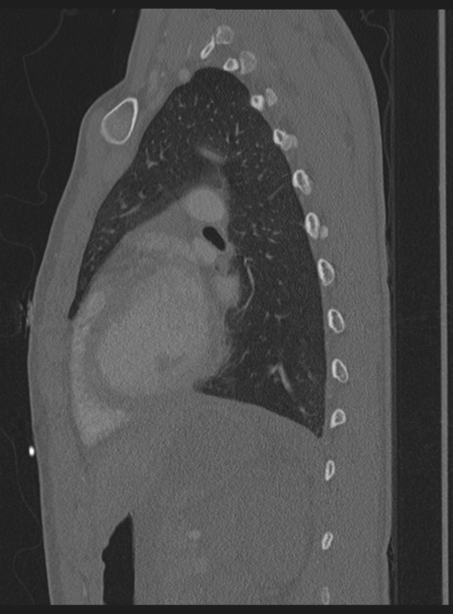 Abdominal multi-trauma - devascularised kidney and liver, spleen and pancreatic lacerations (Radiopaedia 34984-36486 Sagittal bone window 13).png