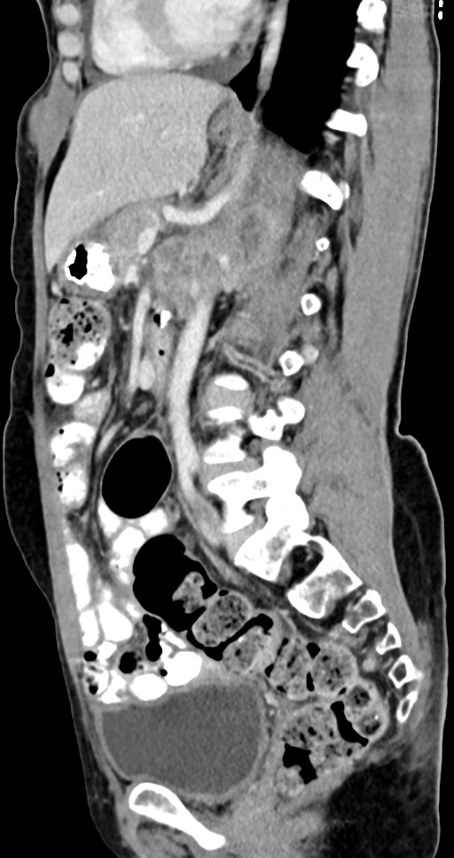 Abdominal wall and retroperitoneal tuberculosis (Radiopaedia 88137-104729 Sagittal C+ portal venous phase 67).jpg