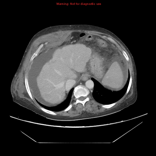 File:Abdominal wall hematoma (Radiopaedia 9427-10112 Axial C+ portal venous phase 21).jpg