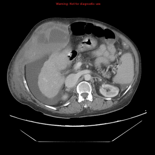File:Abdominal wall hematoma (Radiopaedia 9427-10112 Axial C+ portal venous phase 38).jpg