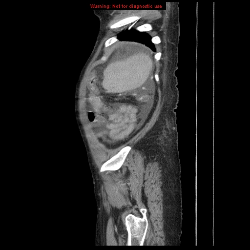 Abdominal wall hematoma (Radiopaedia 9427-10112 Sagittal C+ portal venous phase 16).jpg
