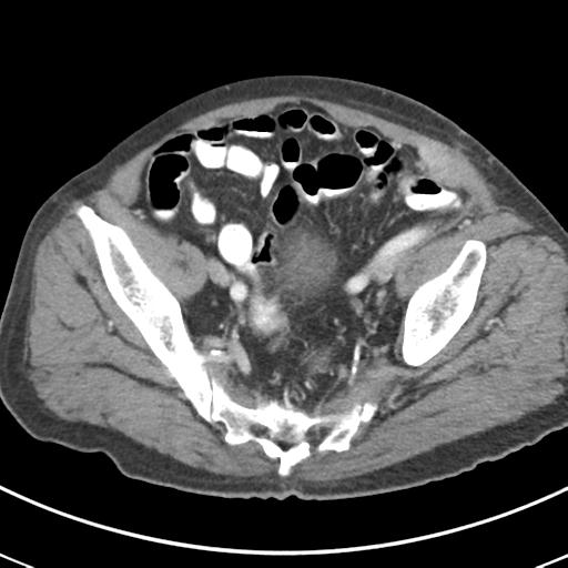 Abdominal wall metastasis from colorectal carcinoma (Radiopaedia 31016-31717 Axial C+ portal venous phase 63).jpg