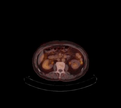 Abdominal wall metastasis from colorectal carcinoma (Radiopaedia 31016-31719 C 68).jpg