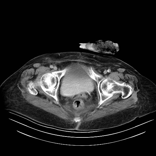 File:Abdominal wall recurrence after colorectal resection for cancer (Radiopaedia 23444-23523 Axial C+ portal venous phase 38).jpg