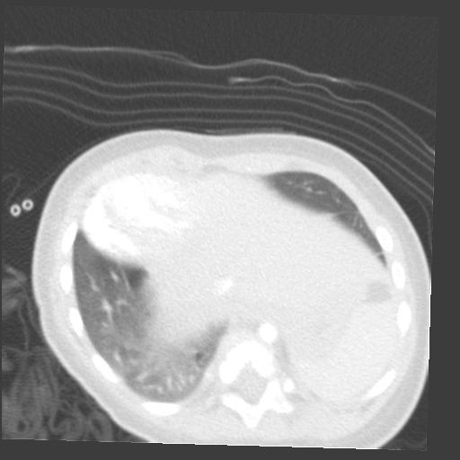 File:Aberrant left pulmonary artery (pulmonary sling) (Radiopaedia 42323-45435 Axial lung window 32).jpg