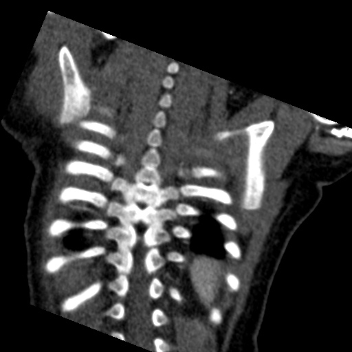File:Aberrant left pulmonary artery (pulmonary sling) (Radiopaedia 42323-45435 Coronal C+ CTPA 3).jpg