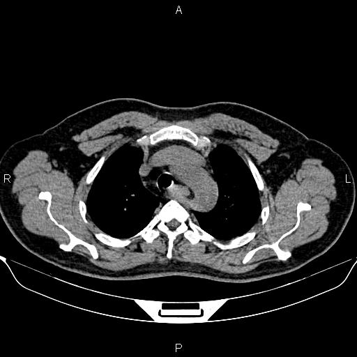 Aberrant right subclavian artery (Radiopaedia 87093-103354 Axial non-contrast 26).jpg