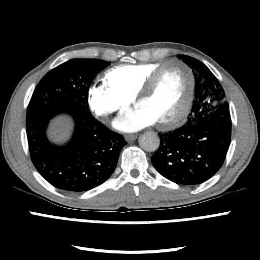 Accessory left horizontal fissure with lingular pneumonia (Radiopaedia 53763-59843 Axial C+ CTPA 65).jpg