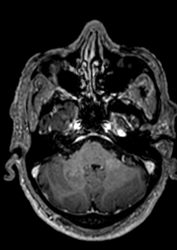 Accessory middle cerebral artery (Radiopaedia 73114-83828 Axial T1 C+ 131).jpg