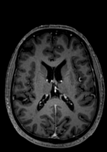 Accessory middle cerebral artery (Radiopaedia 73114-83828 Axial T1 C+ 6).jpg
