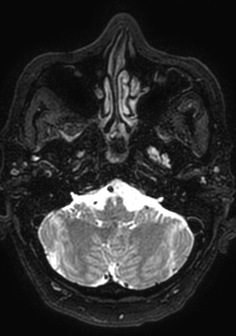 Accessory middle cerebral artery (Radiopaedia 73114-83828 Axial T2 182).jpg