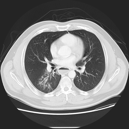 Achalasia (Radiopaedia 8831-9629 Axial lung window 33).jpg