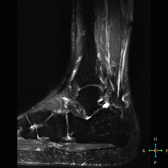 File:Achilles tendon complete tear (Radiopaedia 22834-22854 Sagittal STIR 5).jpg