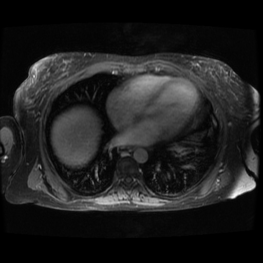 File:Acinar cell carcinoma of the pancreas (Radiopaedia 75442-86668 Axial T1 C+ fat sat 142).jpg