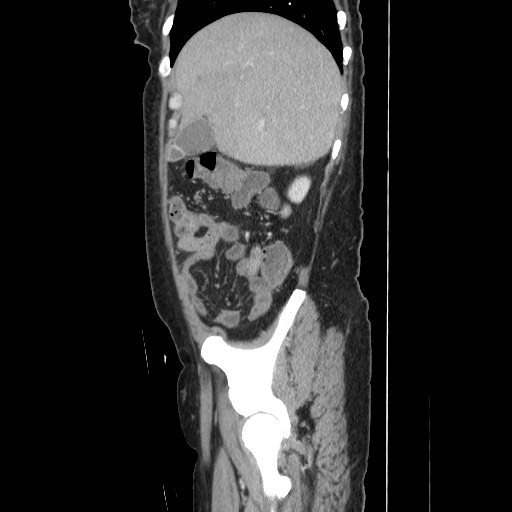 Acinar cell carcinoma of the pancreas (Radiopaedia 75442-86669 Sagittal C+ portal venous phase 52).jpg