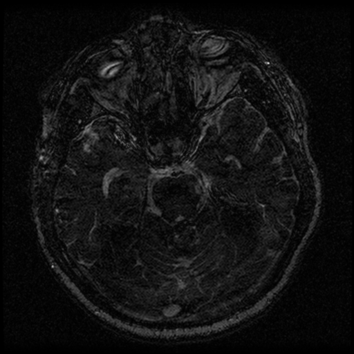 Acoustic schwannoma (Radiopaedia 33045-34060 Axial T2 70).png
