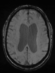 Acoustic schwannoma (Radiopaedia 55729-62281 Axial SWI 33).png