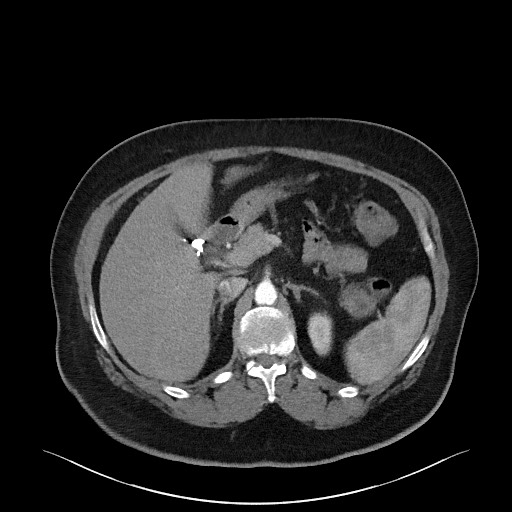Acromioclavicular joint cyst (Radiopaedia 58455-65610 Axial C+ arterial phase 108).jpg