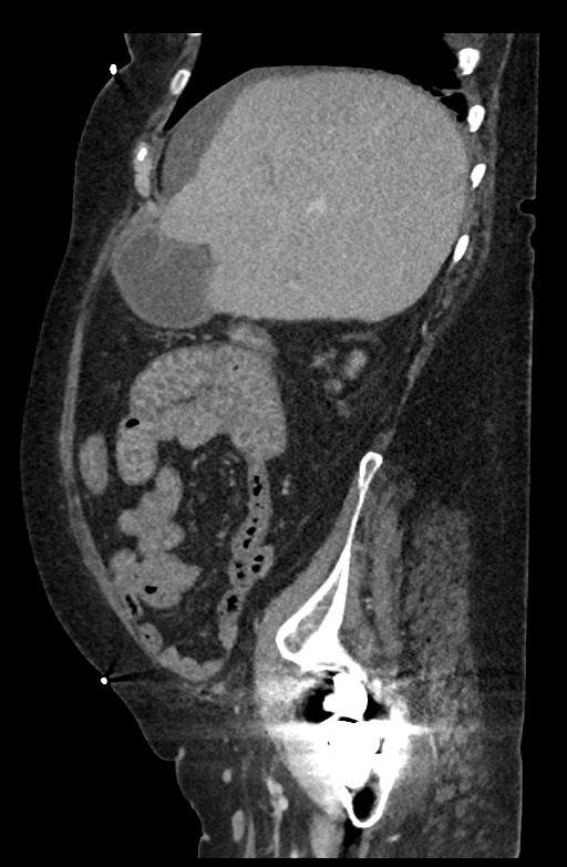 Active renal extravasation with large subcapsular and retroperitoneal hemorrhage (Radiopaedia 60975-68796 Sagittal C+ portal venous phase 164).jpg