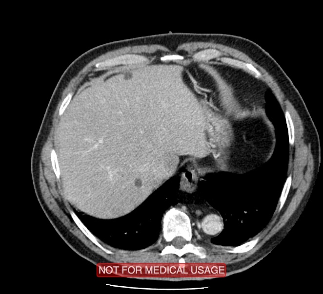 Acute aortic dissection - Stanford type A (Radiopaedia 40661-43285 Axial C+ portal venous phase 54).jpg